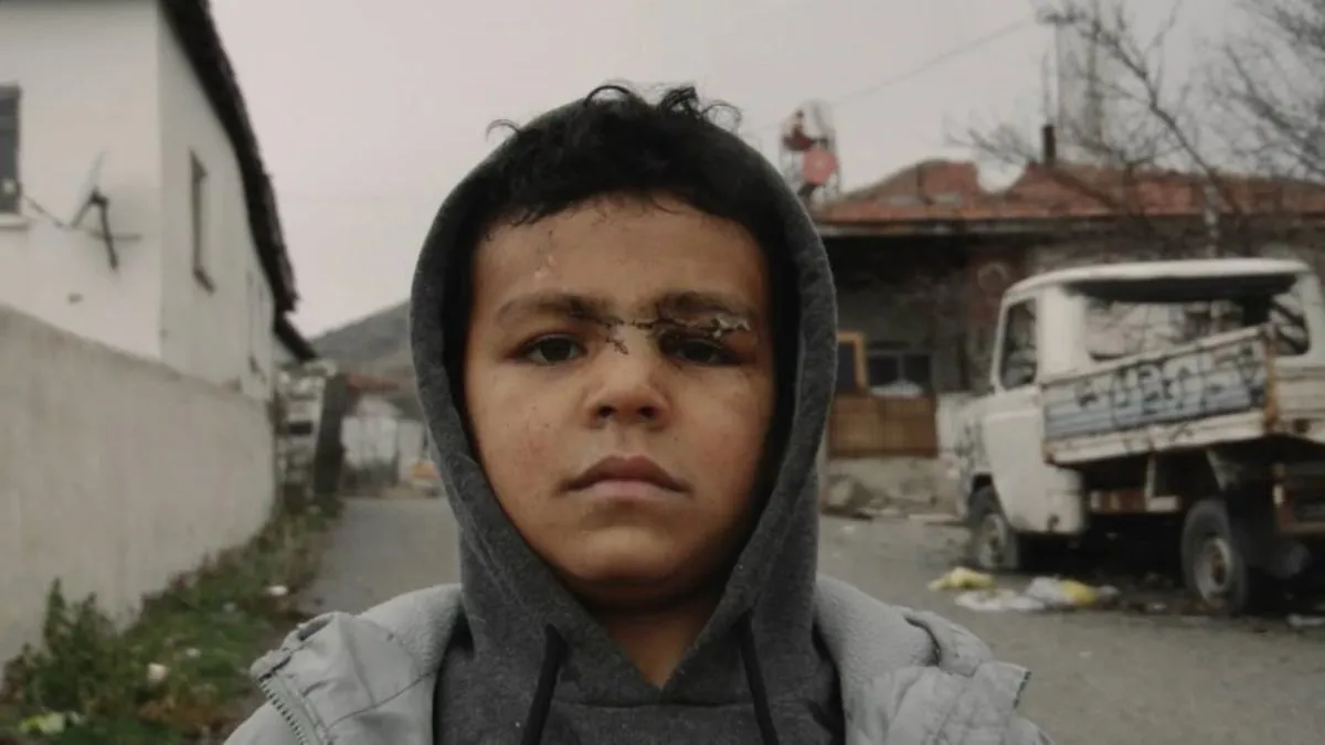 Ankara’da sokak köpeği dehşeti! 5 yaşındaki çocuğun yüzünü parçaladı