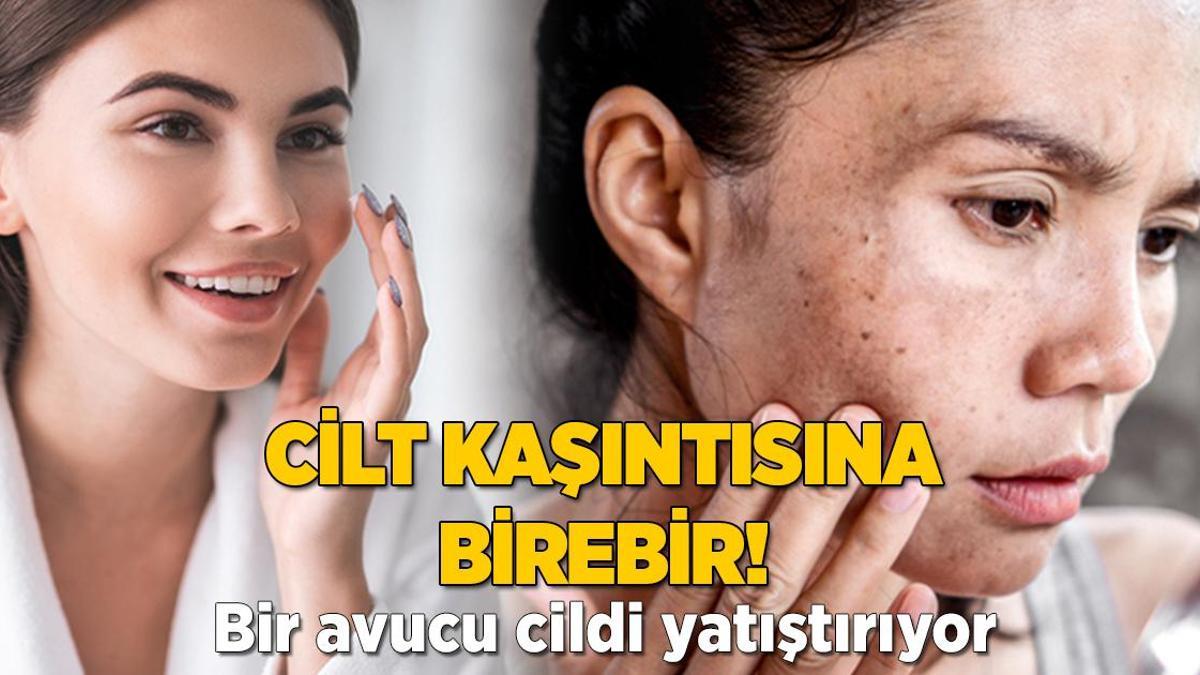 Kaşıya kaşıya yara olan cilde birebir! 15 dakikada yatıştırıyor, üstelik doğal